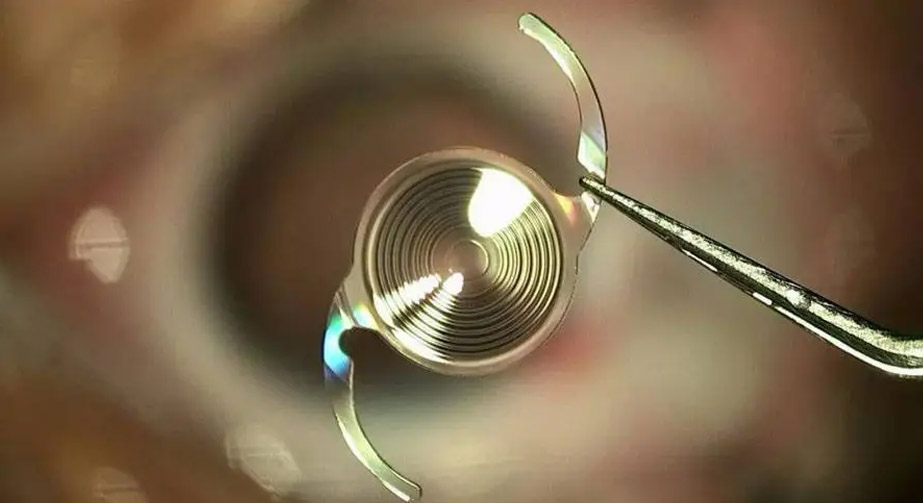 等離子處理在人工晶狀體肝素涂層過程中的應用